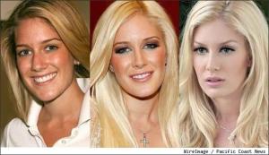 heidi-montag-plastic-surgery-before-and-after-photos-1ooya5s
